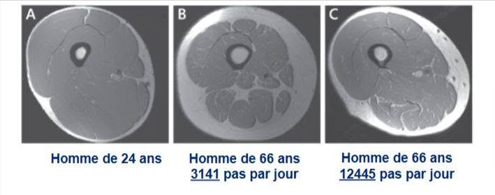 Ces trois images ressemblent à des tranches de jambon. Pourtant, ce sont des coupes IRM (imagerie par résonance magnétique) de cuisses humaines de trois hommes différents.